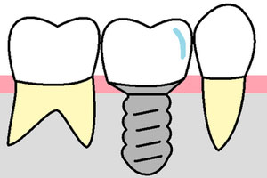 インプラント