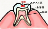 エナメル質の虫歯