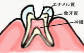 神経に近い象牙質の虫歯