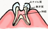 神経に達した虫歯